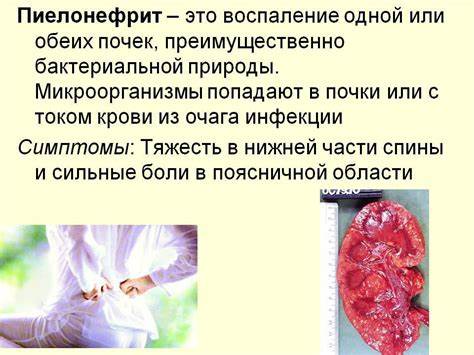Пиелонефрит почек диет Пиелонефрит почек симптомы у женщин и лечение Пиелонефрит почек симптомы у женщин и лечение Пиелонефрит почек диет