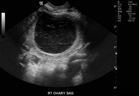 Haemorrhagic Ovarian Cyst Image