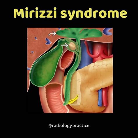 Dr S H Mostafavi On Instagram Mirizzi Syndrome An Uncommon