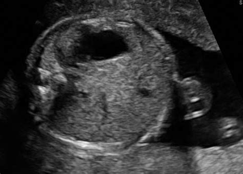 Persistent Non Visualisation Of The Fetal Stomach Diagnostic And