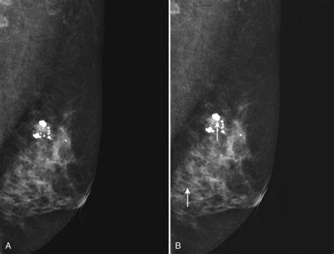 Mammography Acquisition Screen Film And Digital Mammography The