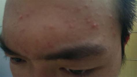 Bumps On Forehead General Acne Discussion Acne Org Forum