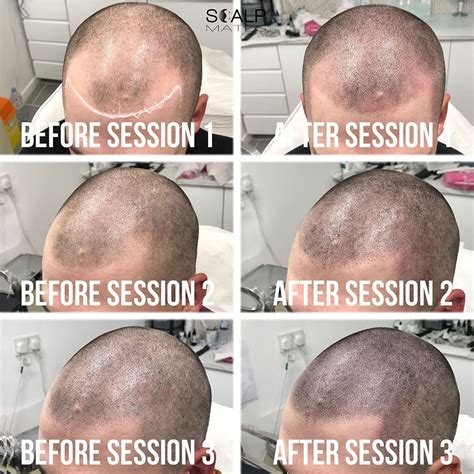 Scalp Micropigmentation The Game Changer Hair Loss Solution