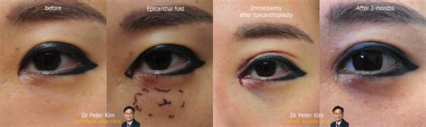 Epicanthic Fold Before After