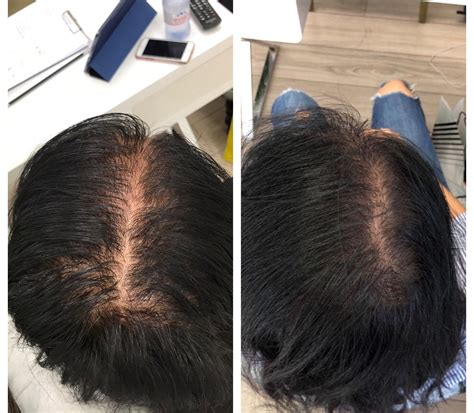 Prp Hair Treatments In London See Our Before Afters The Prp Lab