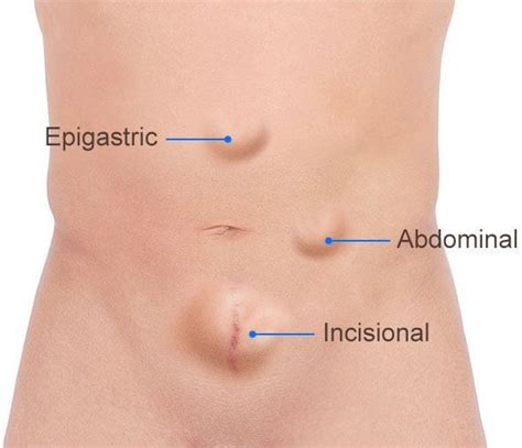 Maybe you would like to learn more about one of these? Incisional Hernia Pictures - Homemade Porn