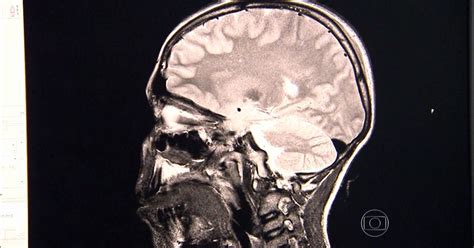 Jornal Nacional Cientistas Que Decifraram O Gps Do Cérebro Ganham O Nobel De Medicina