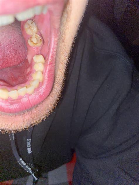 Bumps On Lower Gum Behind Teeth R Askdentists