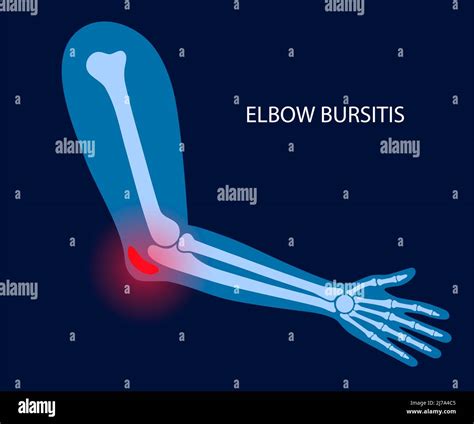 Elbow Bursitis Illustration Stock Photo Alamy