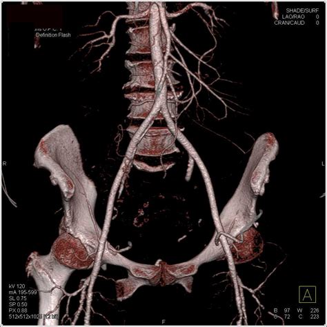 Normal External Iliac Arteries Vascular Case Studies Ctisus Ct Scanning