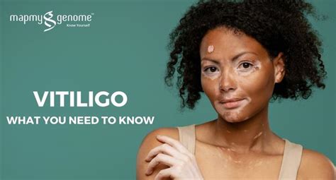 Vitiligo What You Need To Know