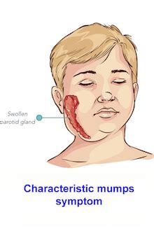 Mumps is a viral disease caused by the mumps virus. Mumps study shows immunity gaps among vaccinated people ...