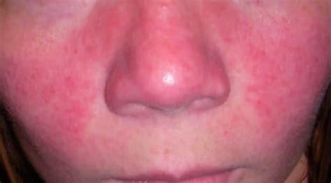 Lupus Rash Pictures Symptoms Causes Treatment