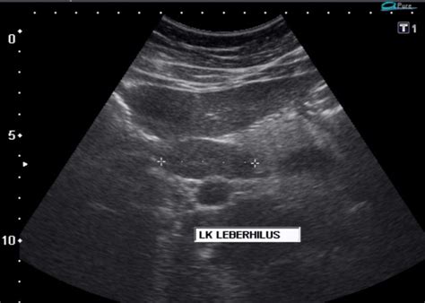 Splenic Marginal Zone Lymphoma Ultrasound Wikidoc