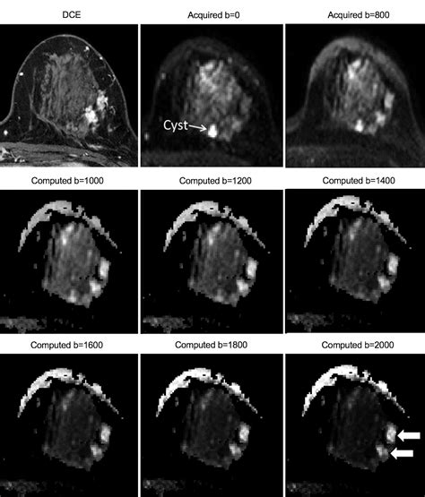 Diffusion Weighted Mri For Unenhanced Breast Cancer Screening Radiology