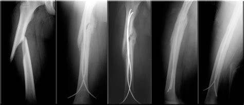 Pre And Post Operative Radiographs Of Femoral Shaft Fracture