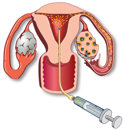 What Is Intra Uterine Insemination