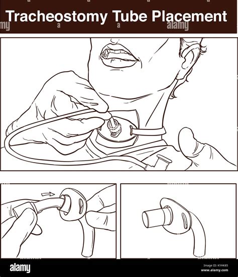 Vector Illustration Of A Tracheostomy Tube Placement Stock Vector Image
