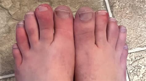 Red Swollen Toes That Hurt The Toe Next To My Pinky Toe Started