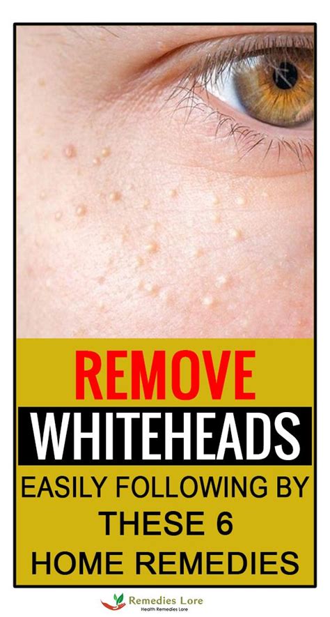Remove Whiteheads Easily Following By These Home Remedies Whiteheads