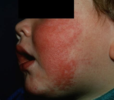 Fifth Disease Causes Incubation Period Rash And Fifth Disease Treatment
