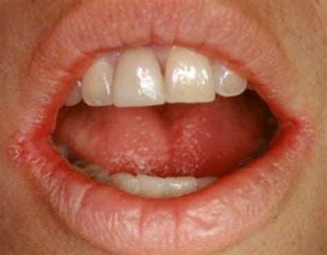 Angular Cheilitis Pictures Treatment Symptoms Causes Hubpages
