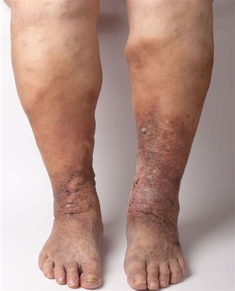 Unter einer thrombose versteht man den verschluss eines blutgefäßes durch ein blutgerinnsel (thrombus). Dicke Beine (Ödeme) - Praxis Klinik Dr.med.Nidal Assaf ...
