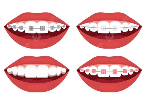 Types Of Braces For Teeth Alignment Metal Ceramic Plastic Ligature And