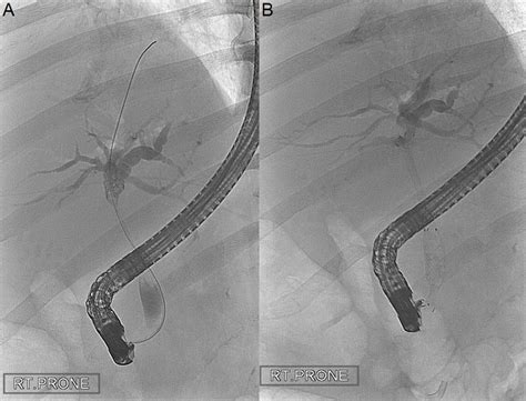 A Perihilar Stricture Identified At Index Ercp Due To Download