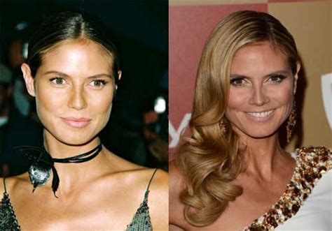 Heidi Klum Plastic Surgery Before And After Nose Job And