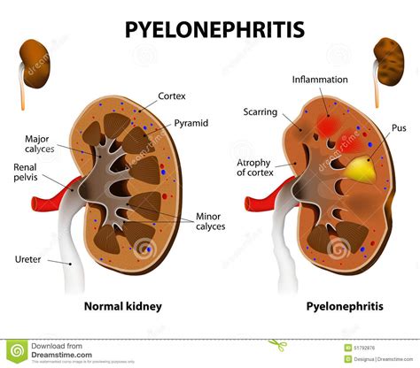 Pielonefritis Aguda Y Cronica Pdf