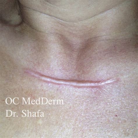 Keloid Treatment Irvine And Orange County Ca Oc Medderm Dermatology