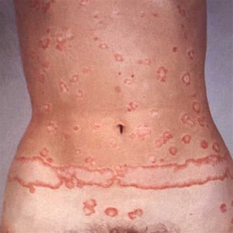 Psoriasis Pictures Signs And Symptoms