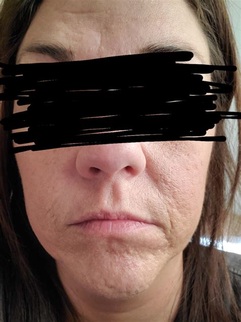 Any Recommendations For The Deep Wrinkleacne Scars Around My Mouth