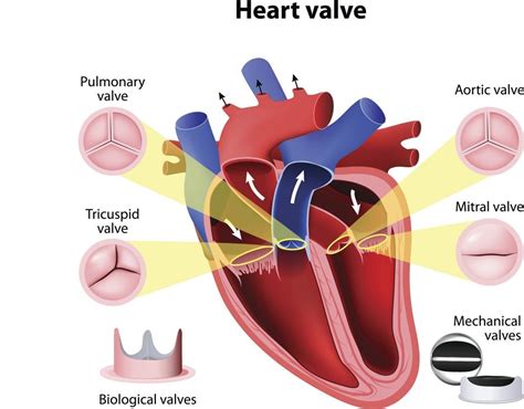 Aortic Valve Insufficiency Also Called Aortic Valve Regurgitation Occurs When The Aortic Valve