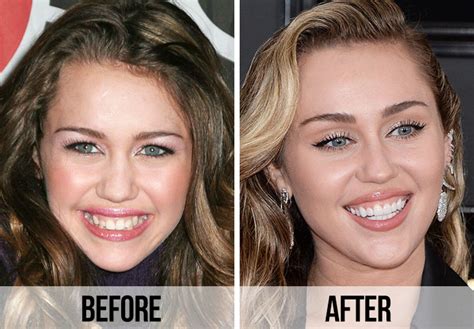 21 Celebrity Dental Implants And Veneers Before And After Shefinds