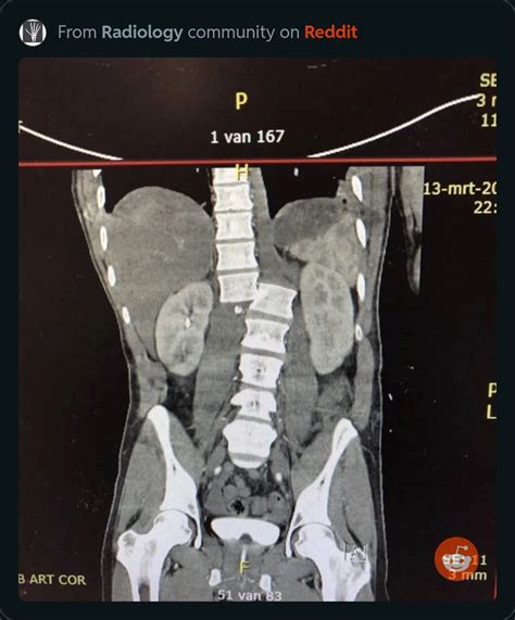 Radrounds Radiology Network On Twitter Diagnosis