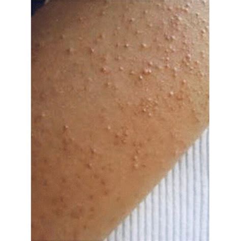 Have You Noticed Little Bumps On The Back Of Your Arms Or Thighs
