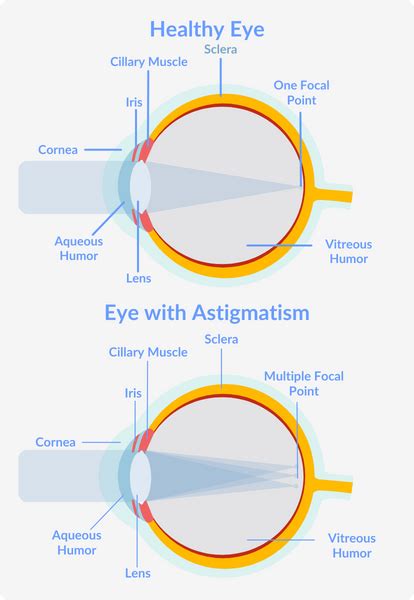 Astigmatism Causes Types Symptoms And Treatment Vision Direct Au