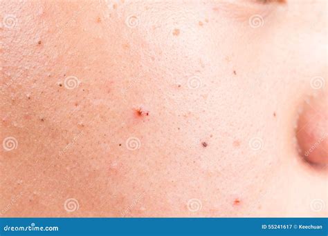 Closed Up Of Pimple Blackheads On The Nose Royalty Free Stock Image
