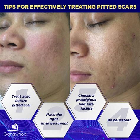 Pitted Scar Treatment Using Autologous Stem Cell Gangwhoo Cosmetic