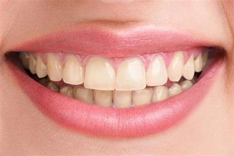 Teeth Whitening At Oakville Dental Care Cosmetic Services