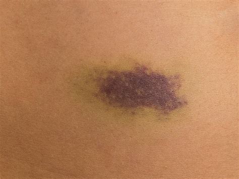 Best Purple Lesion Stock Photos Pictures And Royalty Free Images Istock