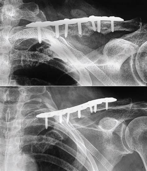 Late recurrent peripheral upper limb ischemia after non ...