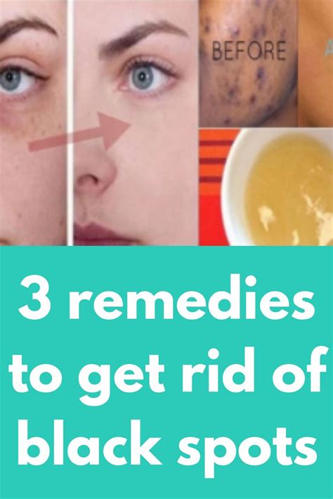 3 Remedies To Get Rid Of Black Spots In Just 15 Minutes Black Spot