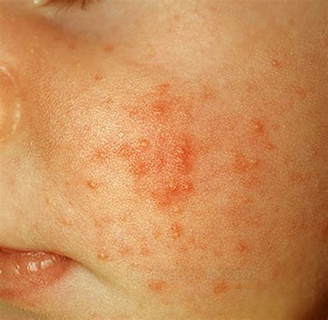 Red Itchy Bumps On Skin Pictures Causes Treatment