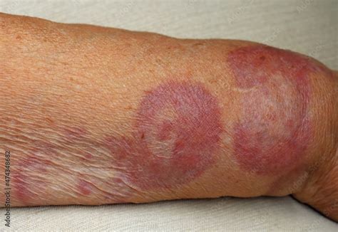 Granuloma Annulare A Rare Skin Disease On An Arm Of A Patient Stock
