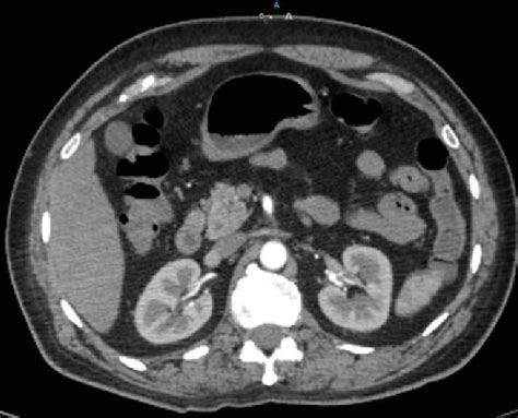 Computed Tomography Scan Of Abdomen Showing Normal Kidneys Download