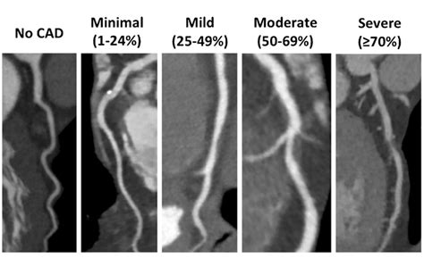 What Is The Heartsmart Ct Scan And What Does It Tell Me Parkview Health