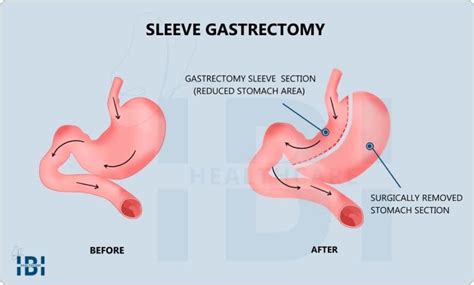 Laparoscopic Sleeve Gastrectomy Lsg Or Vsg Ibi Healthcare